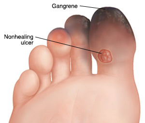 Gangrene- Is this a serious problem?