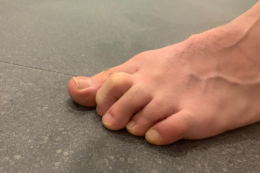 What is claw toe and it's symptoms
