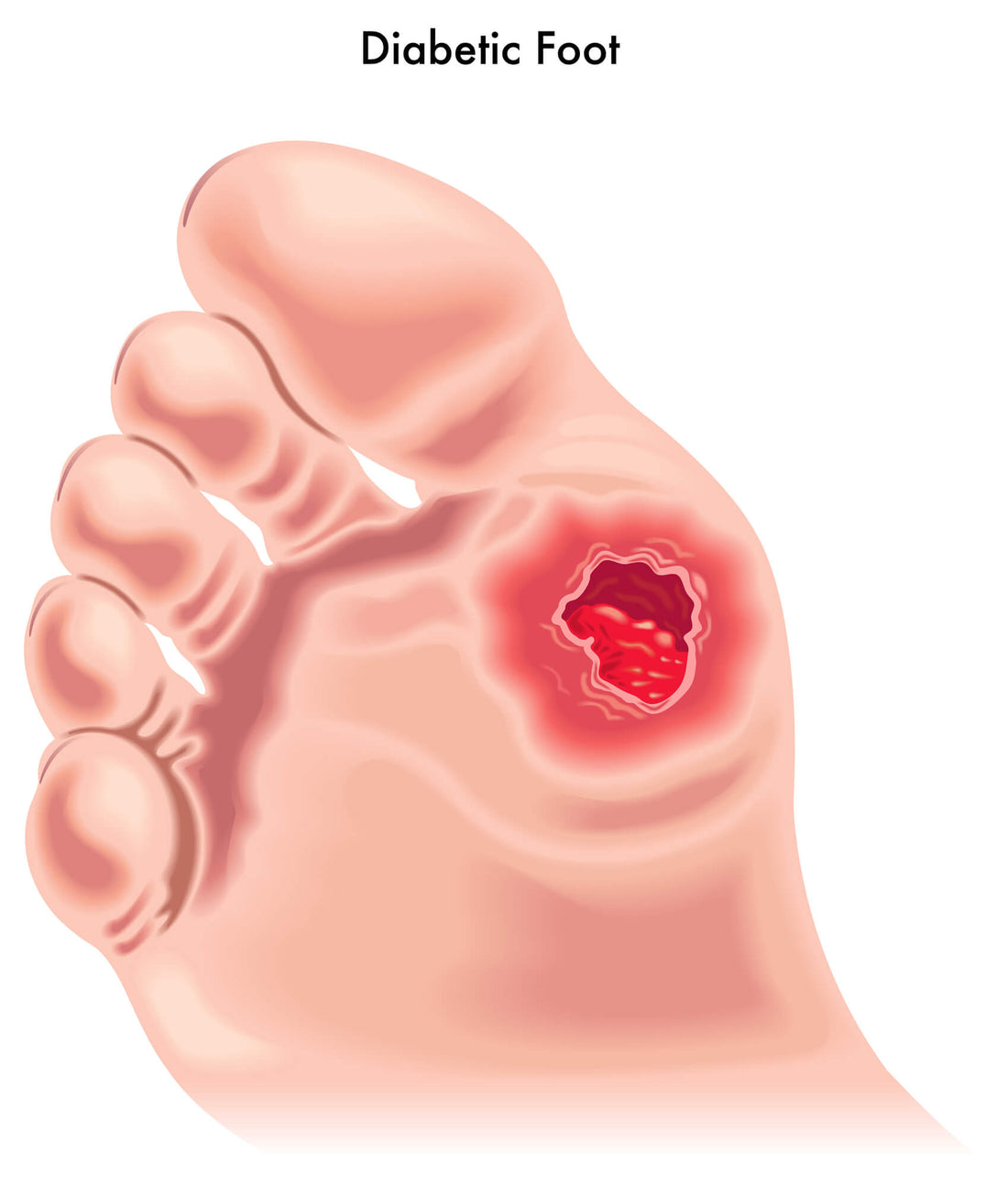 How to prevent amputation for diabetic people?