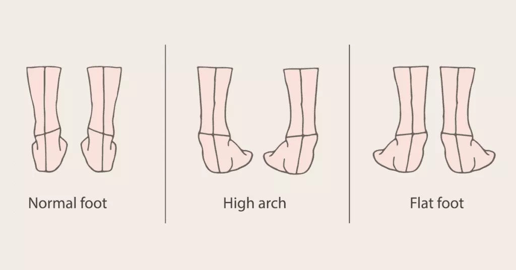 Which one is yours? (foot arch type)