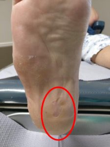 How to treat stone bruise?