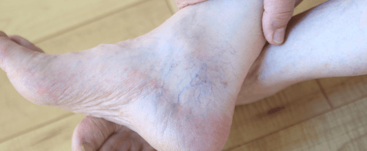 Top 4 Symptoms of Varicose veins
