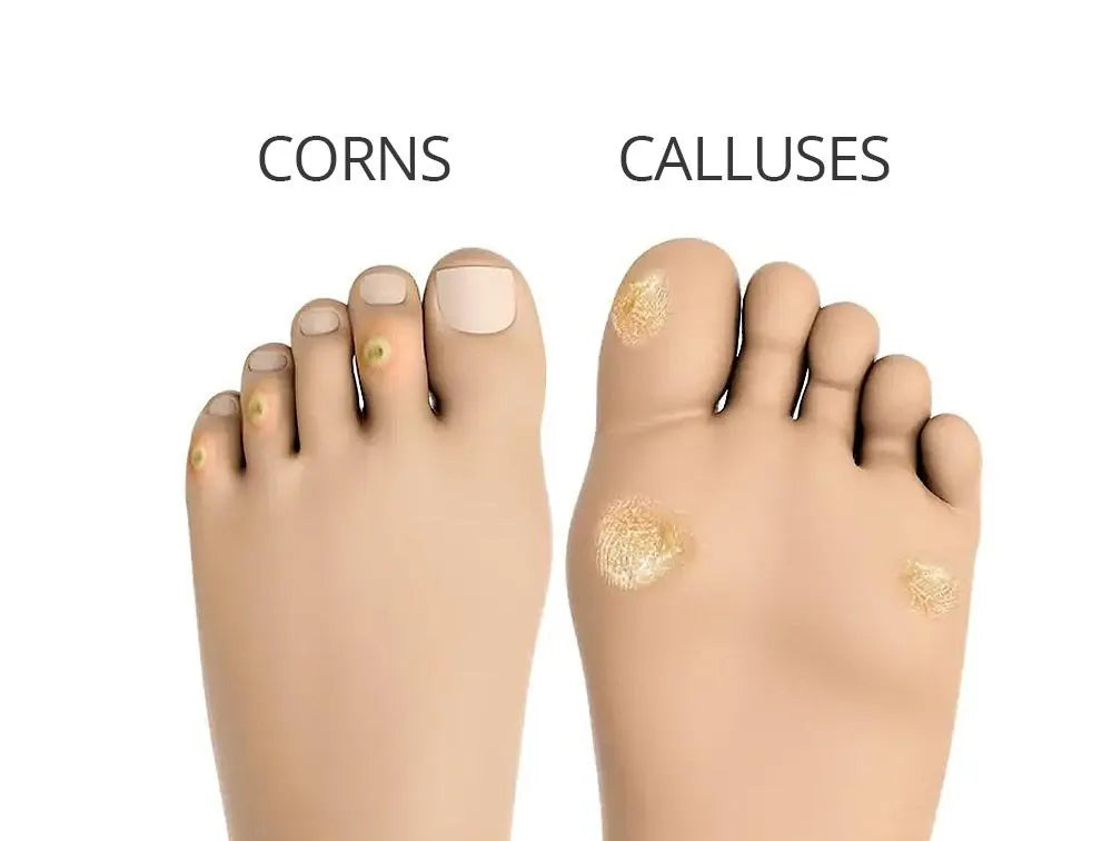 Difference between corns and calluses