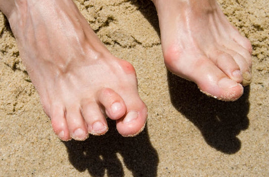 Deformities of toes