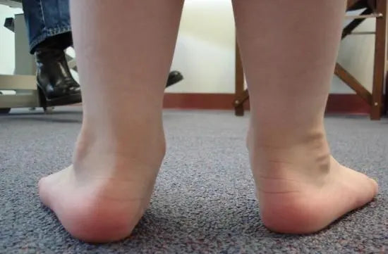 Pronated ankles and flat feet clearance