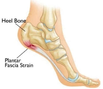 What is plantar fasciitis?