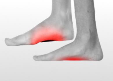 Arch Pain & Flat Foot