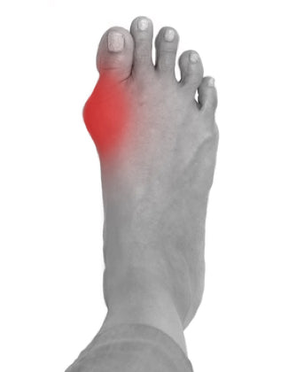 Bunions – HappyWalk - Orthopedic & Diabetic Footwear Store