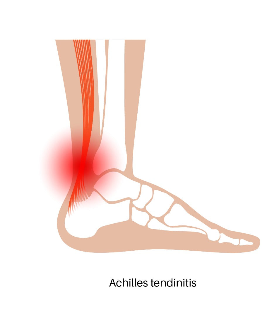 What is Achilles tendinitis? – HappyWalk - Orthopedic & Diabetic ...