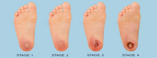 Click here to know about different stages of diabetic foot ulcer