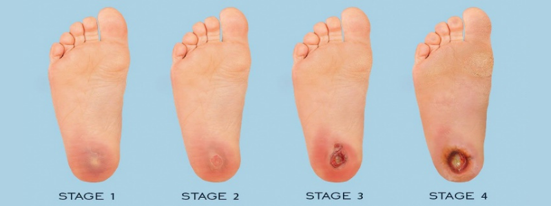 Click here to know about different stages of diabetic foot ulcer