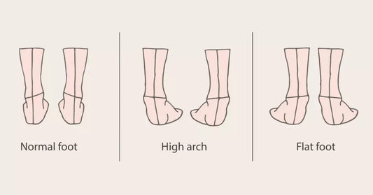 Which one is yours? (foot arch type)