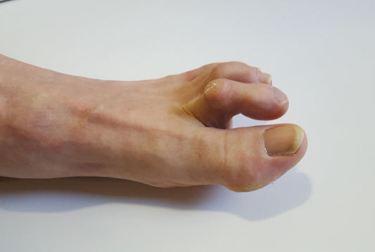 How to get rid of Hammer toe?