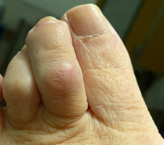What is Hammer toe?