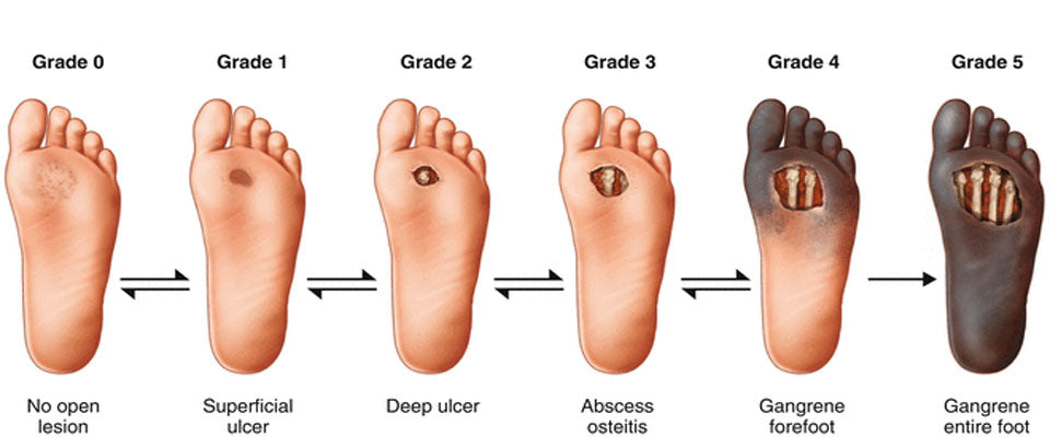 How diabetic foot occur?