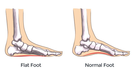 Learn more about Foot deformities