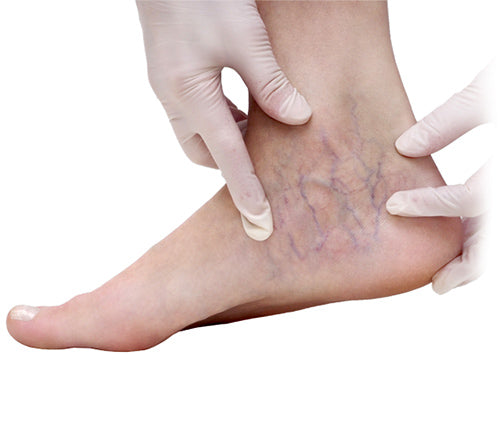 What is Varicose veins?