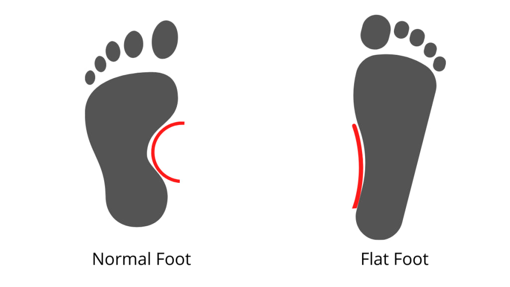 Different types of Flat foot