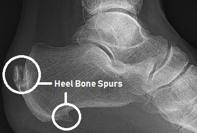 Heel spur or Calcaneal spur and it's symptoms.
