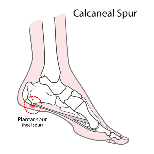 Calcaneal Spur treatment