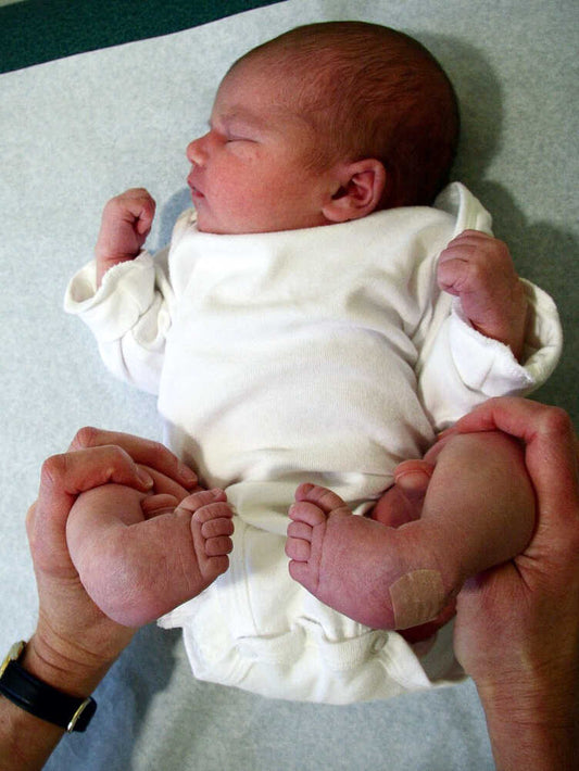 Baby's club foot