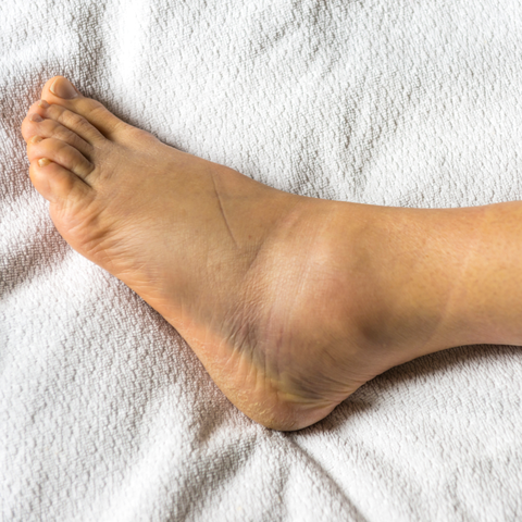 What is swollen feet?