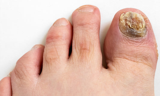Infections in foot through dirty nails occurrence????